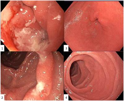 Case report and review of literature: IgG4-gastroduodenitis in upper GI Crohn’s disease: two separate entities or just a marker of disease severity?